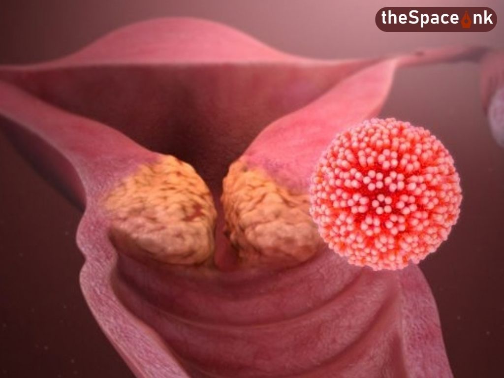 Cervical Cancer is Preventable