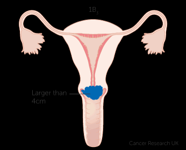 Cervical Cancer is Preventable